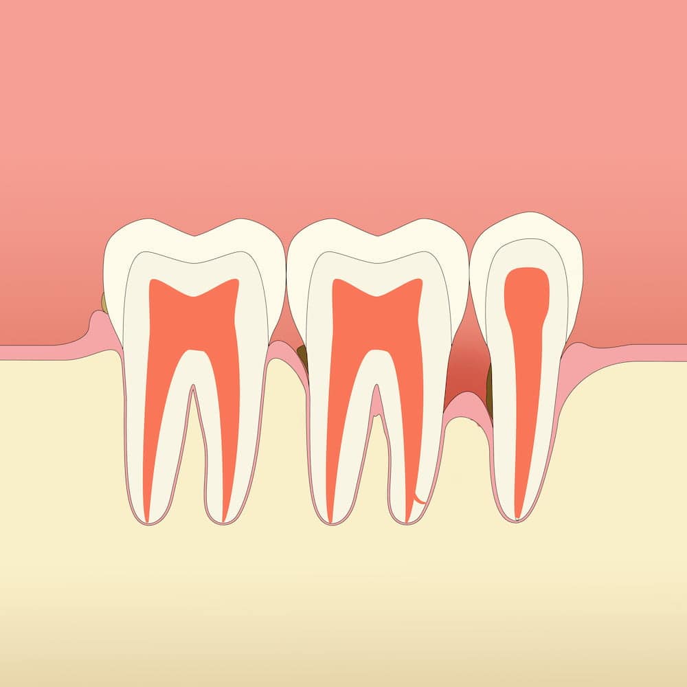 Parodontitis Knochenabbau